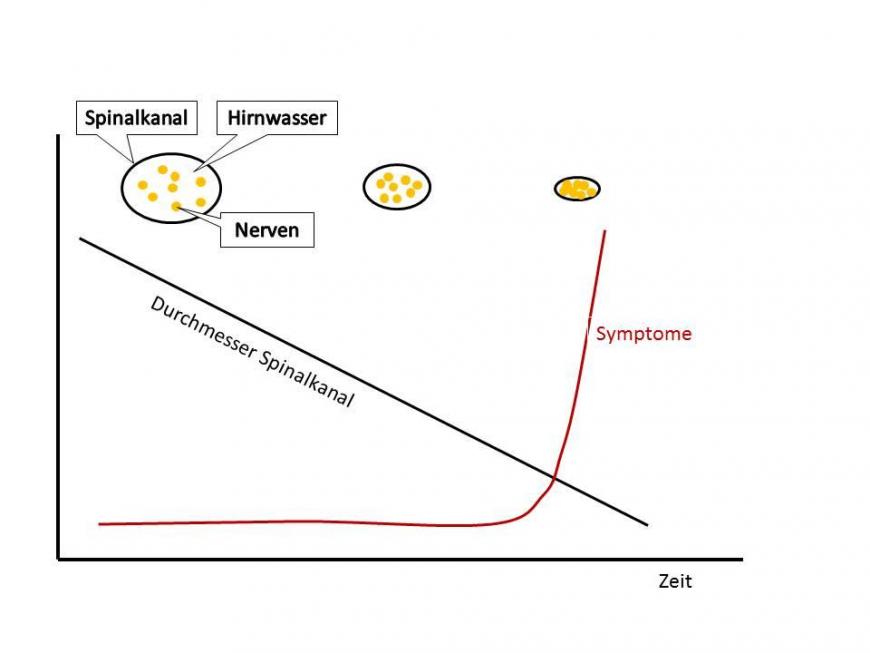 Verlauf der Symptomatik bei der Spinalkanalstenose