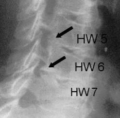 Enge der Nervenaustrittslöcher 