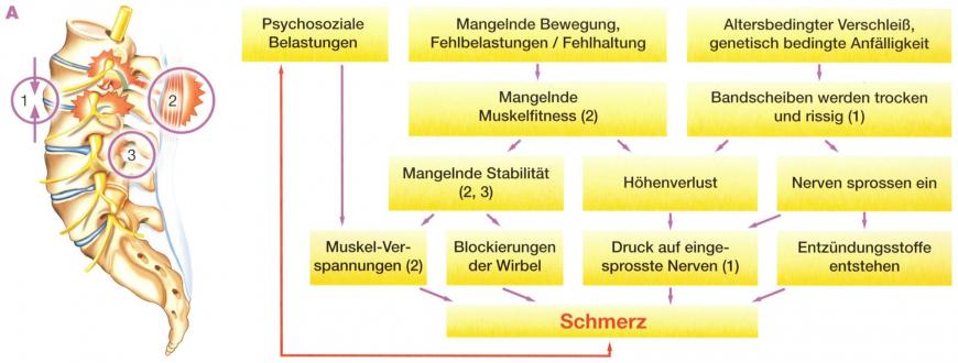 Warum schmerzt der Rücken?